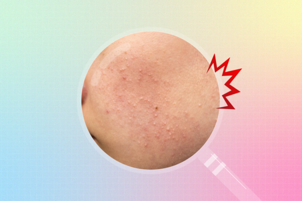 Comedonal-Acne (2)