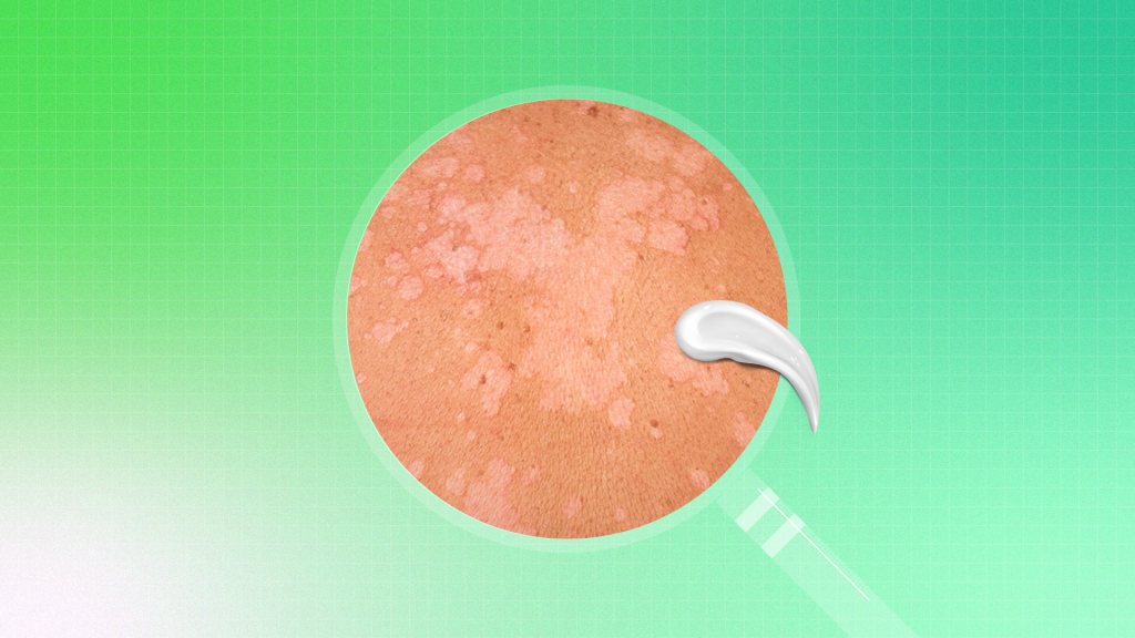 Apa Perlu Buat Untuk Hilangkan Panau Di Muka? – glowwe