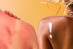 Sunburn-vs-Suntan