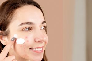 SPOT ACNE TREATMENT