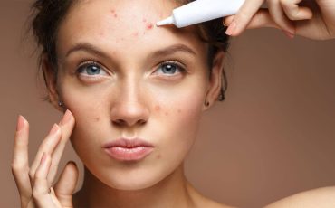 Medical-Acne-Treatment-Ensoul-Clinic-1