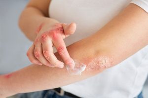 Different_Types_of_Eczema_eea42fe793