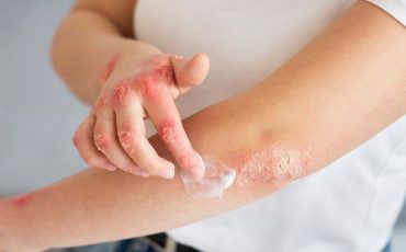 Different_Types_of_Eczema_eea42fe793