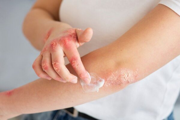 Different_Types_of_Eczema_eea42fe793