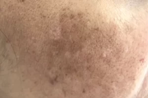 Hyperpigmentation_Causes_and_Treatment_37a14c66-307e-43b8-8d7d-6067415d2cf6