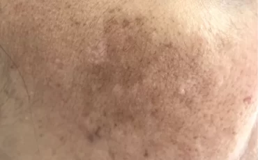 Hyperpigmentation_Causes_and_Treatment_37a14c66-307e-43b8-8d7d-6067415d2cf6