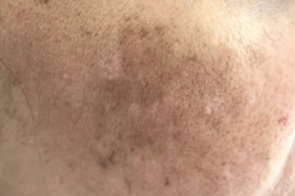 Hyperpigmentation_Causes_and_Treatment_37a14c66-307e-43b8-8d7d-6067415d2cf6